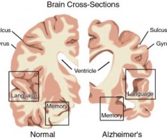 alzheimer-cervello