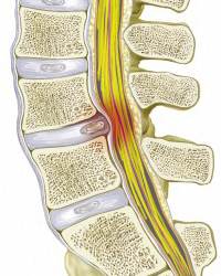 ernia disco intervertebrale