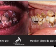 carie-bevande-dietetiche