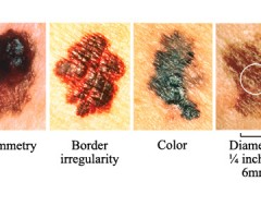 melanoma