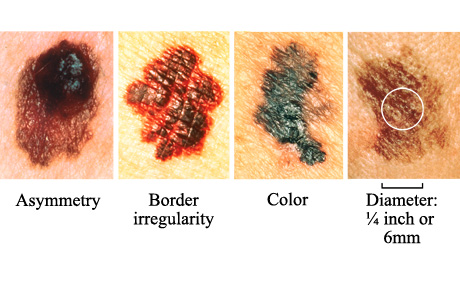 melanoma