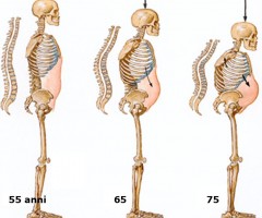 osteoporosi