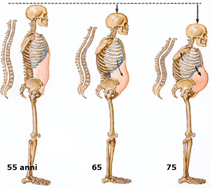 osteoporosi