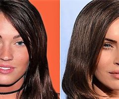 Fillers all' acido ialuronico