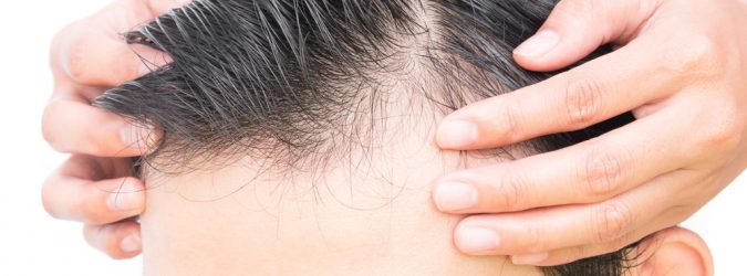 Trapianto di capelli