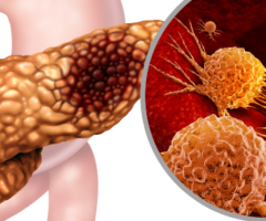 Tumore al pancreas