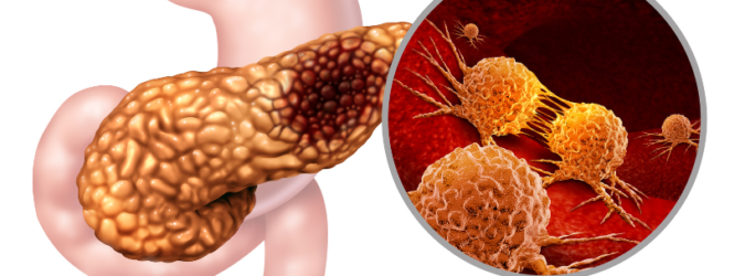 Tumore al pancreas