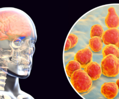 Meningite tubercolare