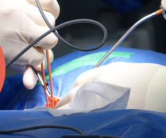 intervento di neurochirurgia