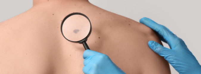 Melanoma