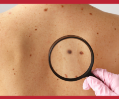 melanoma