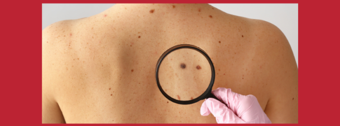 melanoma