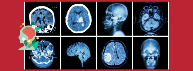 ictus, Giornata mondiale ictus, Asst Lariana, ospedale Sant’Anna, Stroke Unit, Alessia Lanari, riabilitazione, assistenza domiciliare, neurologia, caregiver