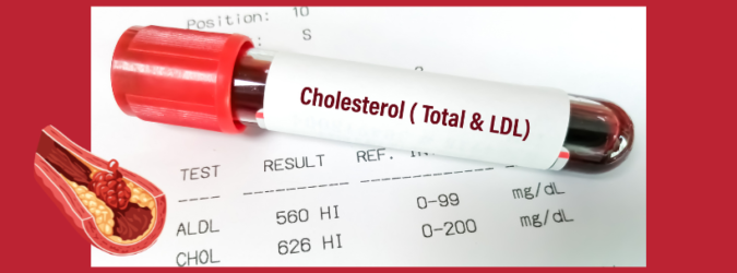 colesterolo, colesterolo LDL, statine, intolleranza alle statine, ezetimibe, acido bempedoico, PCSK9, inclisiran, enlicitide, rischio cardiovascolare